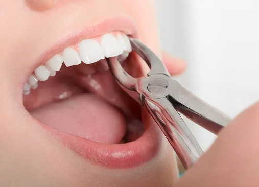 Erupted Wisdom Tooth Extraction