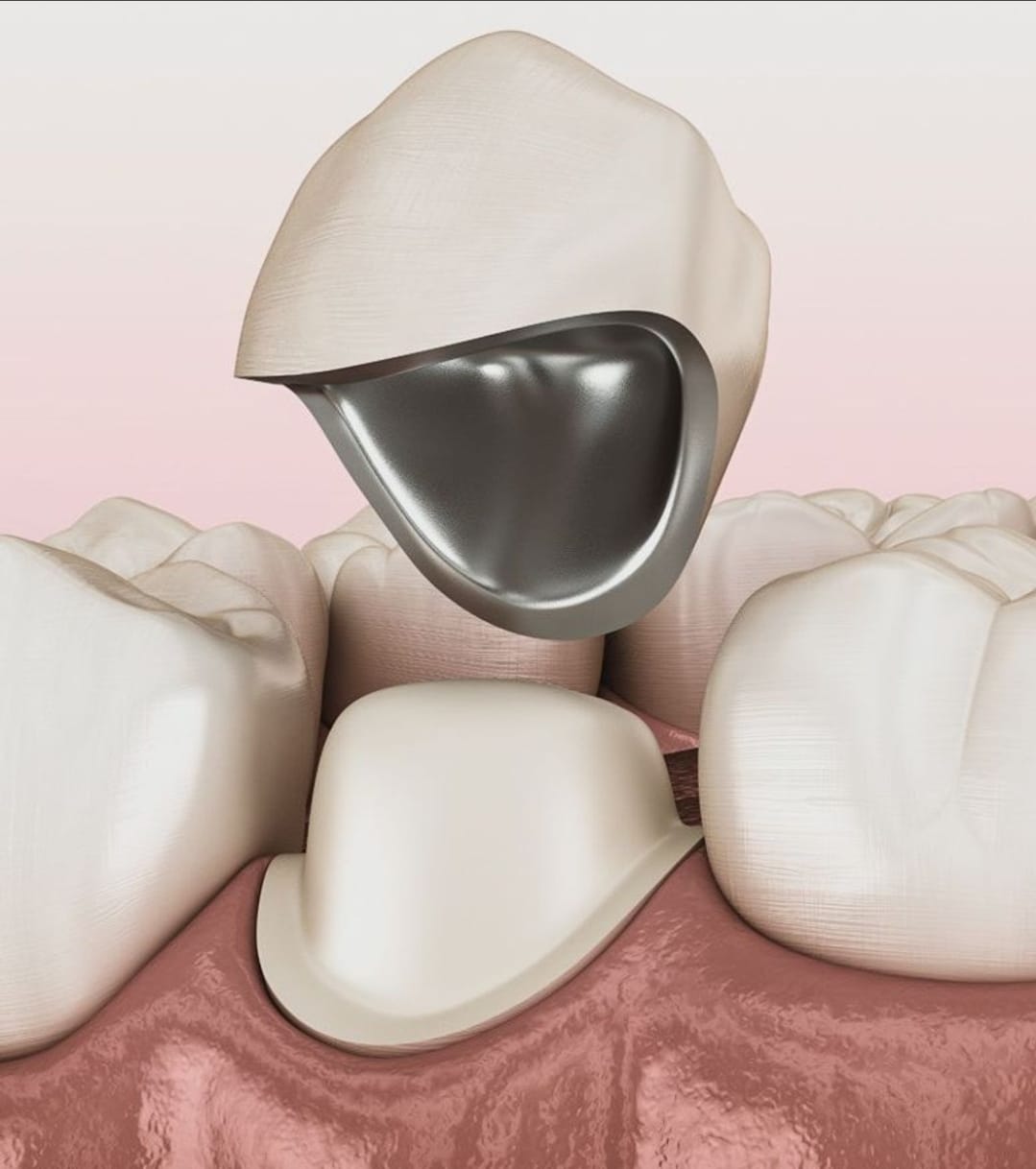 Porcelain-Fused-to-Metal (PFM) Crowns