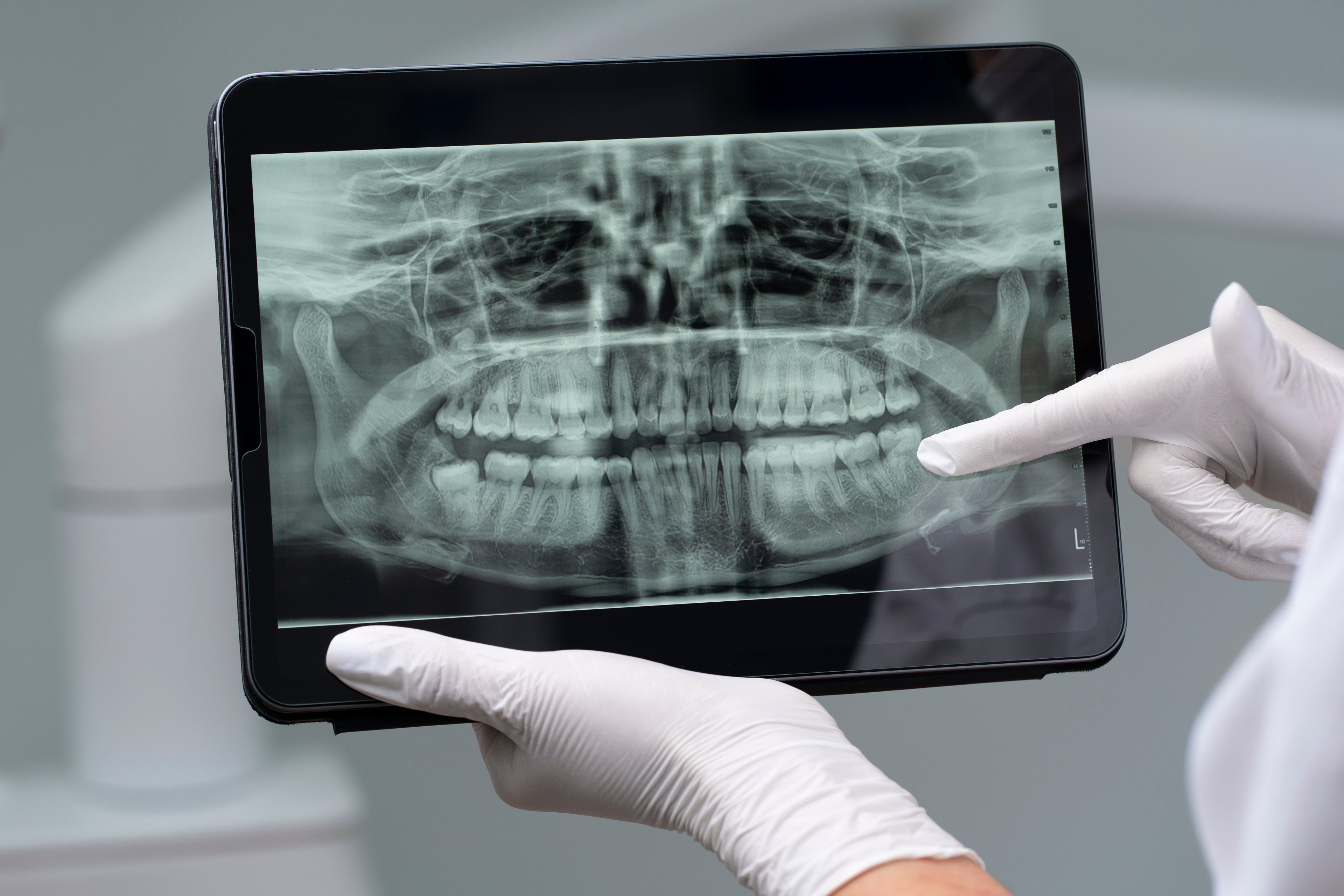 Digital X-Rays