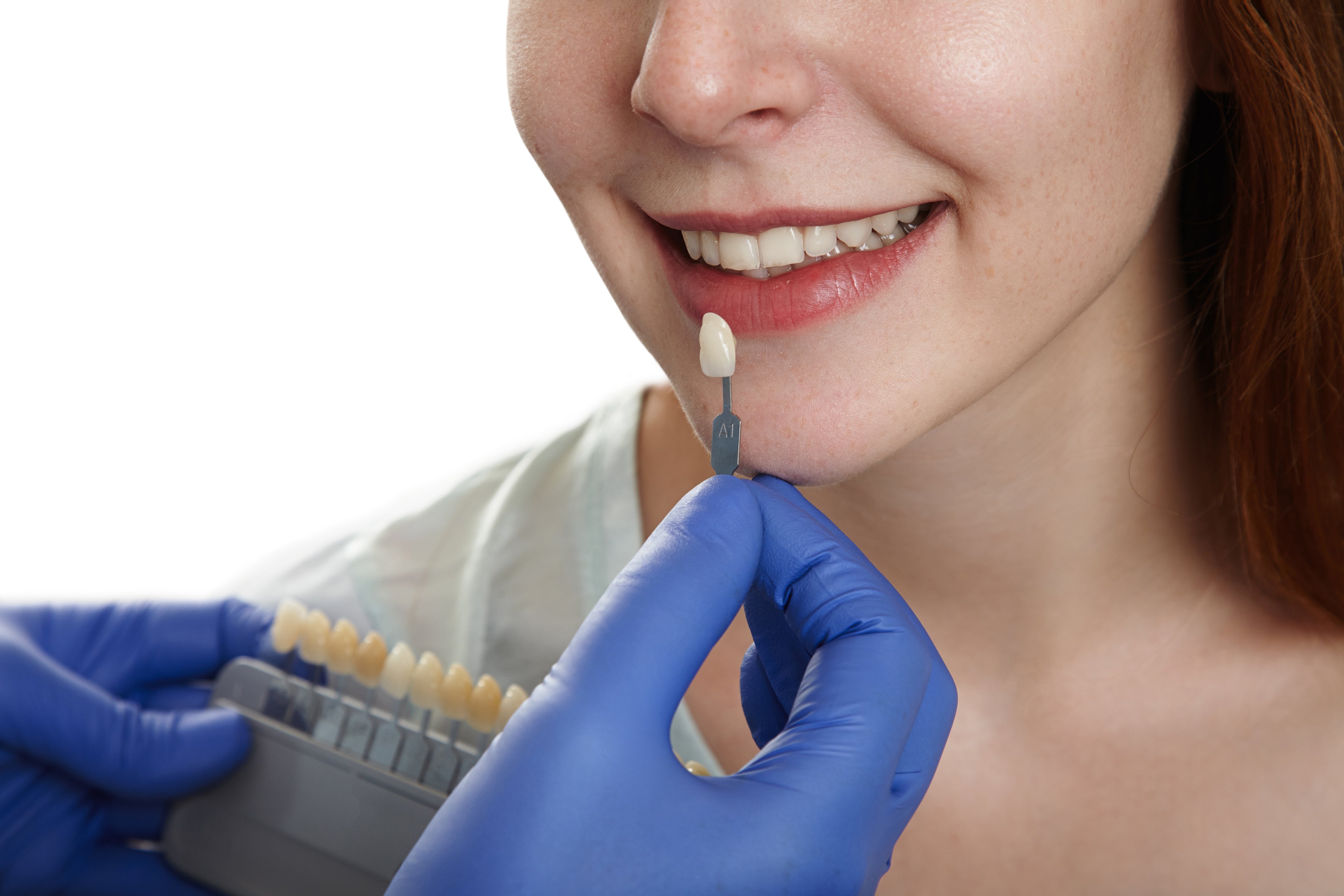 PMMA Temporary Crowns (Provisional Restorations)