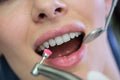Professional Dental Cleaning (Scaling & Polishing)