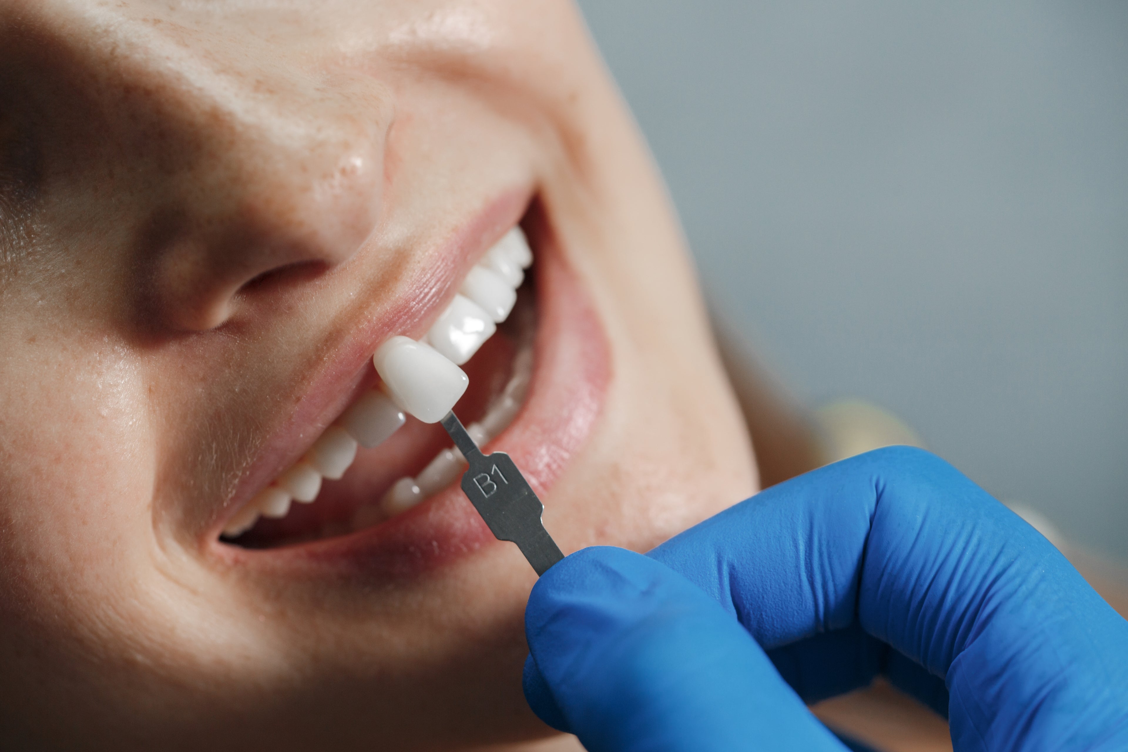 E-max Veneers