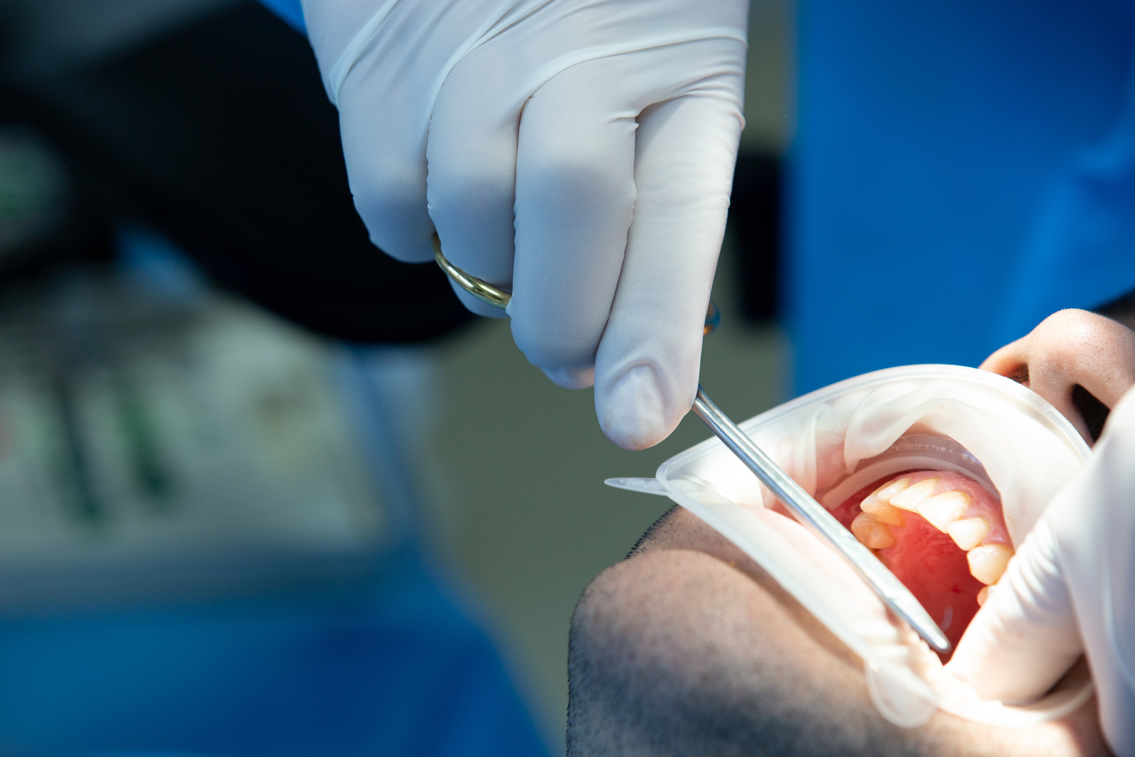 Multi-Root Tooth Extractions