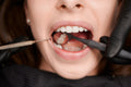 Tooth-Coloured Fillings (Simple & Multi-Surface)