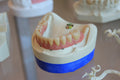 All-on-6 Dental Implants (Full-Arch Restoration)