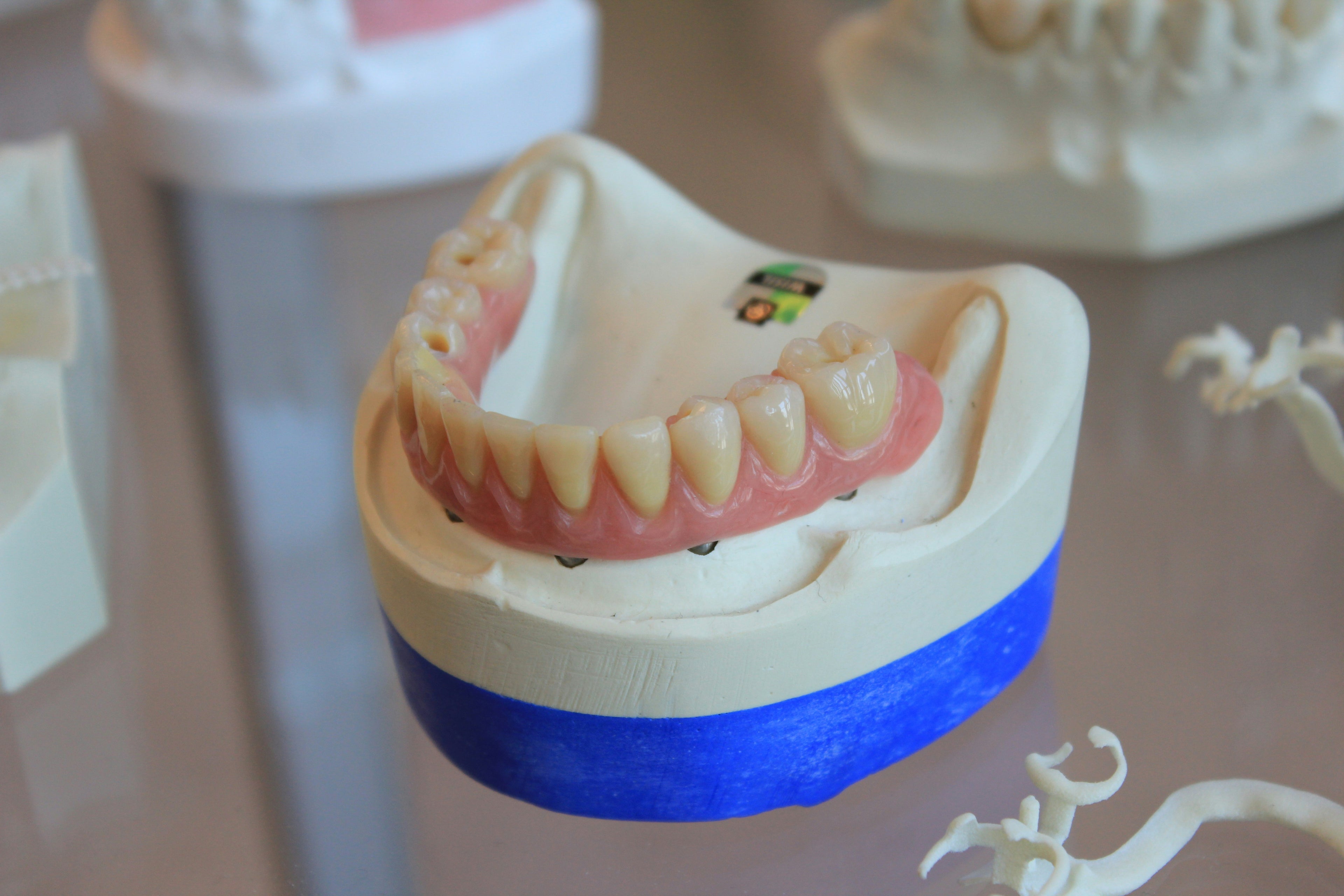 All-on-6 Dental Implants (Full-Arch Restoration)