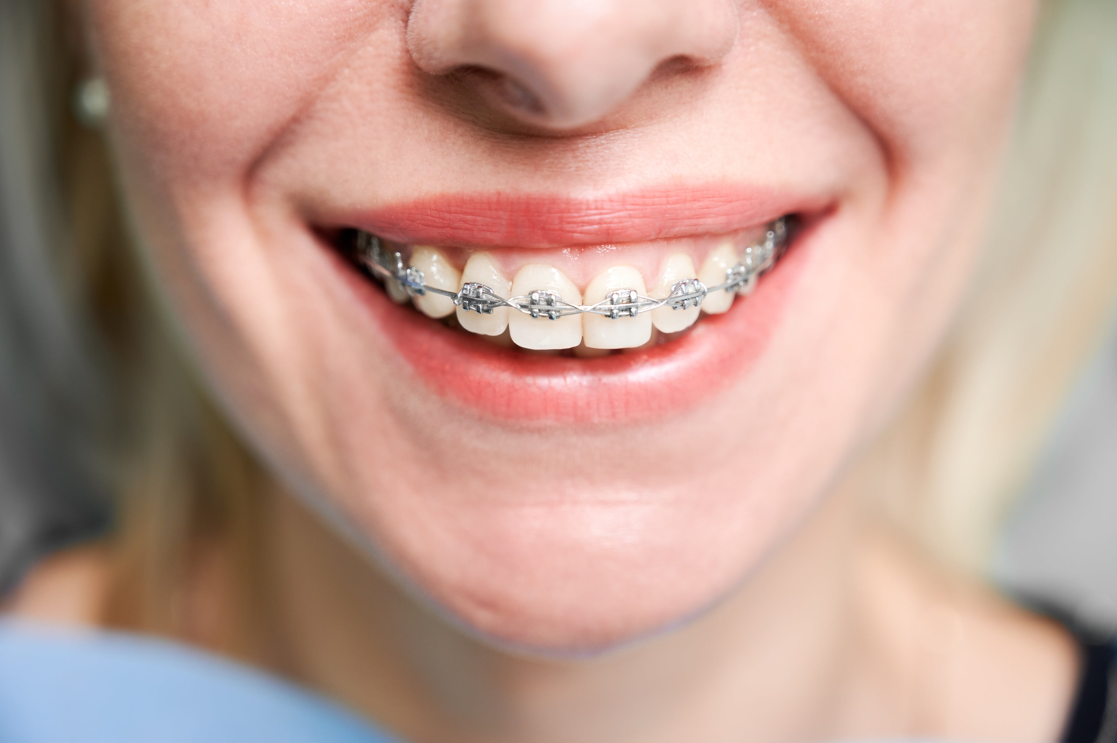 Traditional Braces