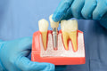 Single Dental Implants